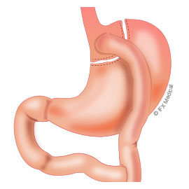 gastric-bypass