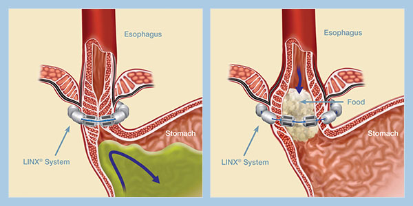 Linx-Reflux-Management-System-Diagram