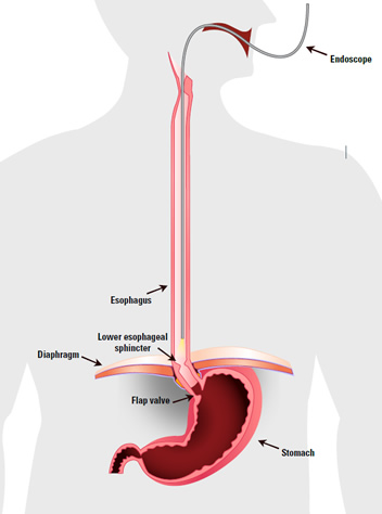 upper-endoscopy